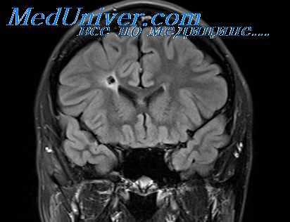 абсцесс мозга