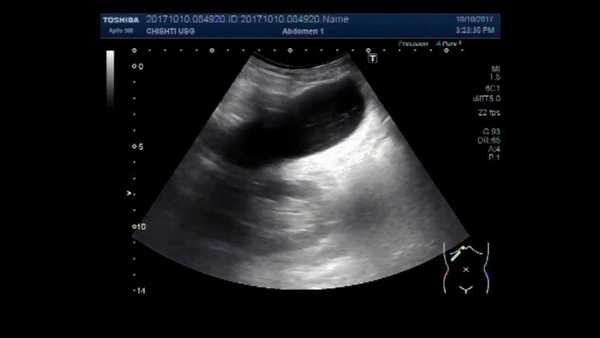 рак желчного пузыря на узи