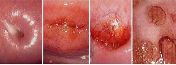 Что видно внутри при простой кольпоскопии