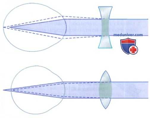 Нормальное зрение - эмметропия. Дальнозоркость и близорукость