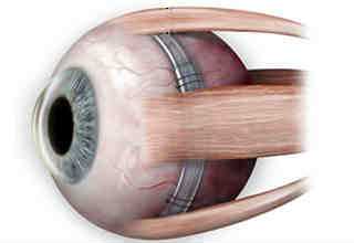 Эписклеральное пломбирование сетчатки