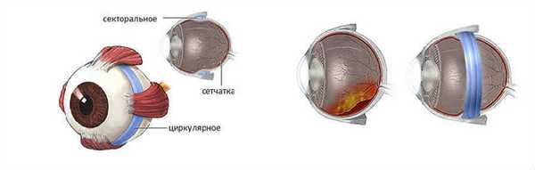 Цены на операцию эписклерального пломбирования сетчатки в Москве