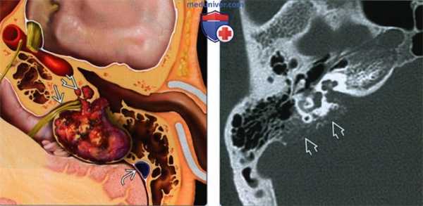 Опухоль эндолимфатического мешка (ОЭЛМ) - лучевая диагностика