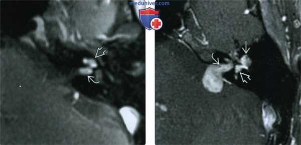 КТ, МРТ при интралабиринтной шванноме
