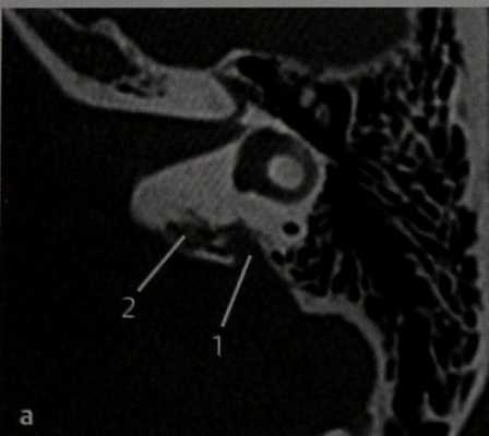 Снимки МРТ и КТ. Опухоль эндолимфатического мешка: болезнь Гиппеля