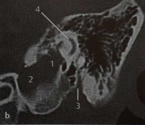 Снимки МРТ и КТ. Опухоль эндолимфатического мешка: болезнь Гиппеля