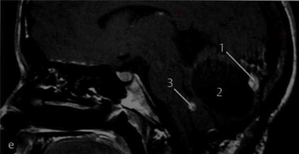 Снимки МРТ и КТ. Опухоль эндолимфатического мешка: болезнь Гиппеля