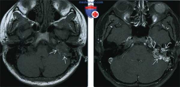 Опухоль эндолимфатического мешка (ОЭЛМ) - лучевая диагностика