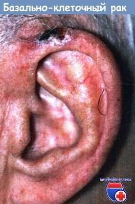 Базально-клеточный рак