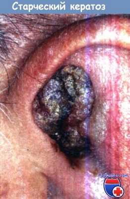 Старческий кератоз