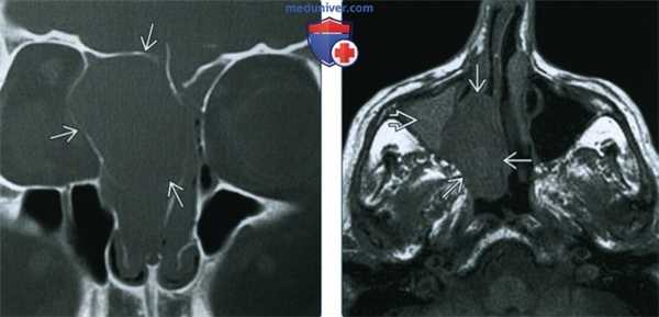 Опухоль оболочки нервов пазухи, носа - лучевая диагностика