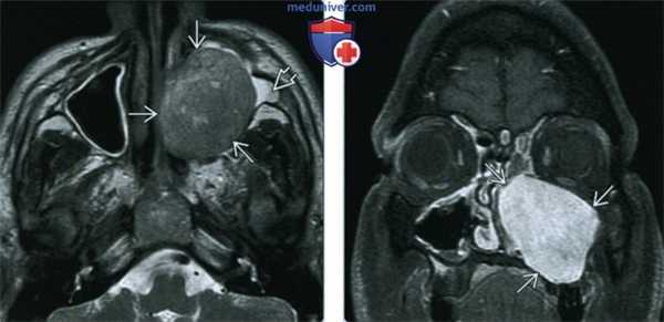 Опухоль оболочки нервов пазухи, носа - лучевая диагностика