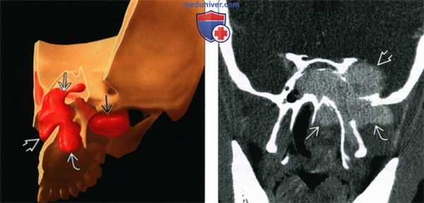 КТ, МРТ при ювенильной ангиофиброме носа