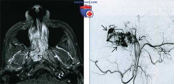 КТ, МРТ при ювенильной ангиофиброме носа