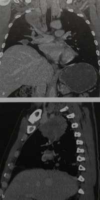 Снимки МРТ и КТ. Опухоль Панкоста
