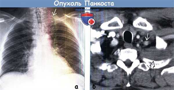 Опухоль Панкоста на рентгенограмме и КТ