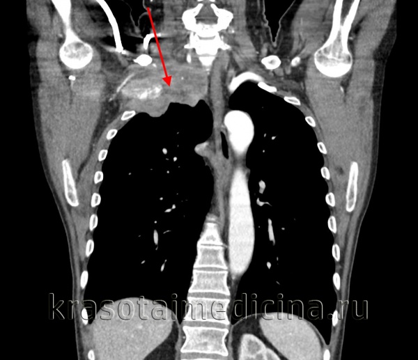 КТ ОГК С+. Опухоль верхушки правого легкого с вовлечением окружающих костных и мягкотканных структур.