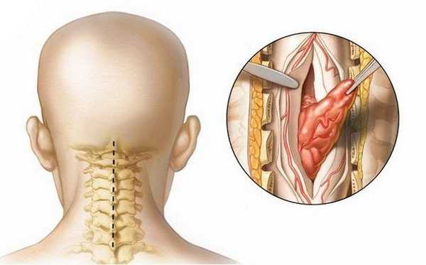 Доброкачественная опухоль более «мягкая» и избавиться от нее проще, чем от злокачественной, которая отличается скоростью развития и возникновением осложнений