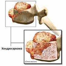 Опухоли позвоночника