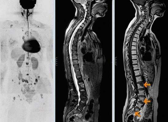 Метастазы при раке позвоночника могут распространиться практически по всему организму, затронув любые органы