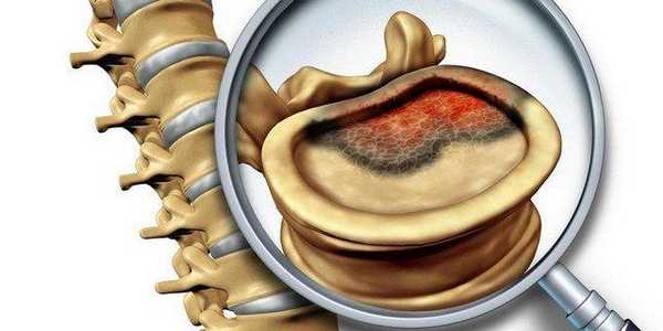 Рак позвоночника симптомы и проявление