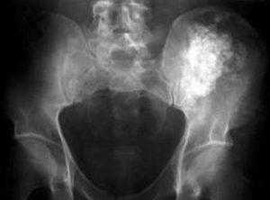 Опухоли позвоночника