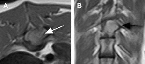 Опухоли позвоночника