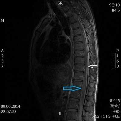 Изображение интрадуральной опухоли на снимке МРТ