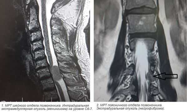 МРТ опухолей спинного мозга