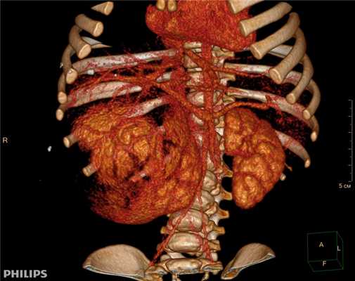 3D-реконструкции опухоли Вильмса