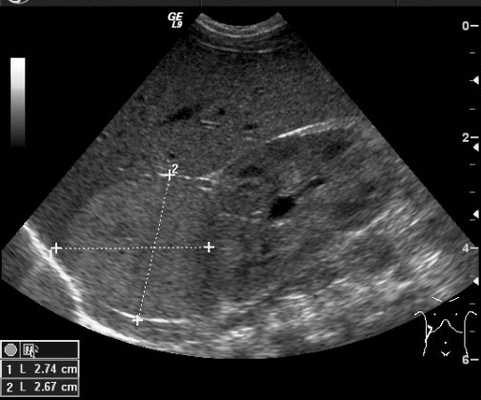 Рис. 4. УЗИ образования правого надпочечника