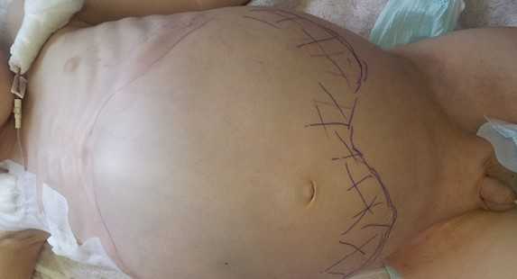 Рис. 2. Нейробластома забрюшинного пространства