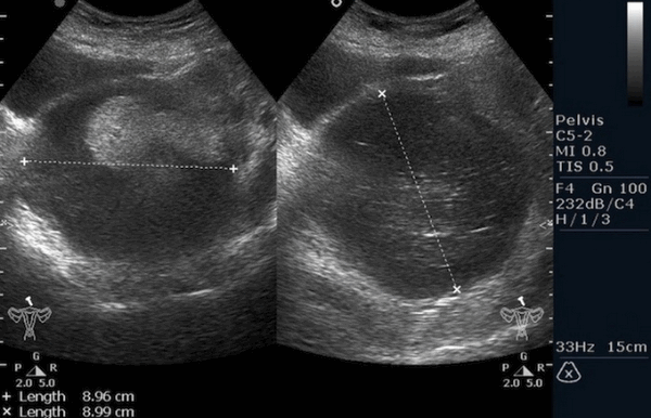 Тератома яичника (УЗИ)