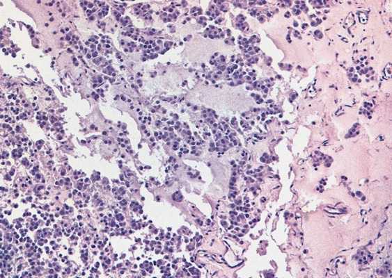 Микропрепарат, семинома