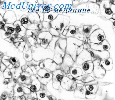 гонадобластома яичек