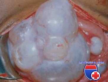 опухоли яичек