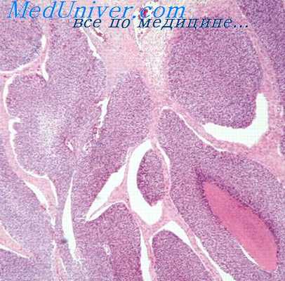 опухоли полового члена