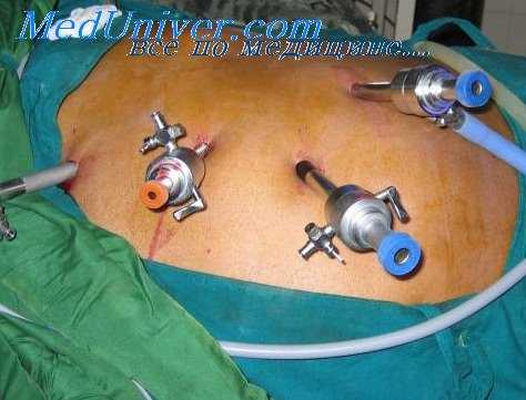 лапароскопия при остром животе