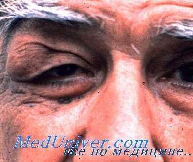 Аденома слезной железы