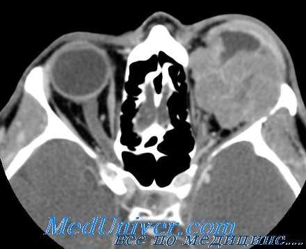 КТ при рабдомиосаркоме глазницы