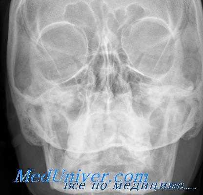 рентгенография глазницы