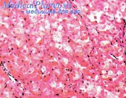 Опухоль из клеток Лейдига