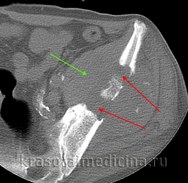 Гигантоклеточная опухоль кости