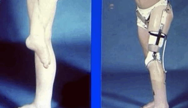 Рис.10 Ротационная пластика