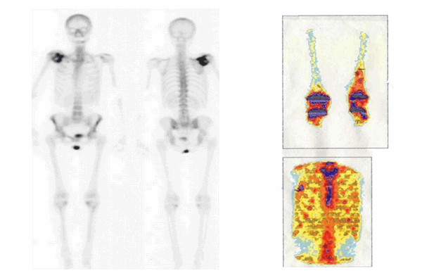 Рис.3. Патологическое накопление радиофармпрепарата (Технеций mTc)