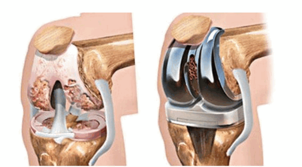 Рис. 5. Тотальное эндопротезирование коленного сустава состоит из трех компонентов: бедренного, большеберцового и надколенникового