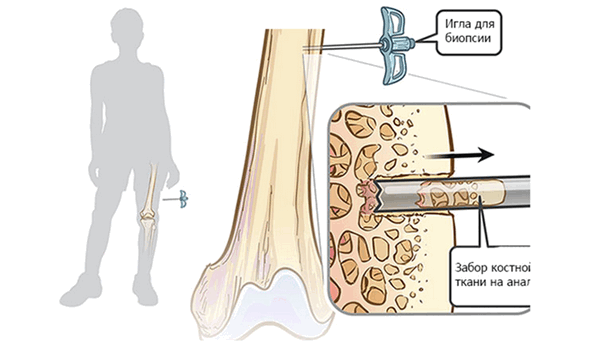 Рис.4: Биопсия с применением трепан-иглы