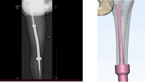 Рис. 6. Артродезирование