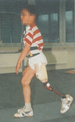 Рис.9 Экзопротезирование нижней конечности