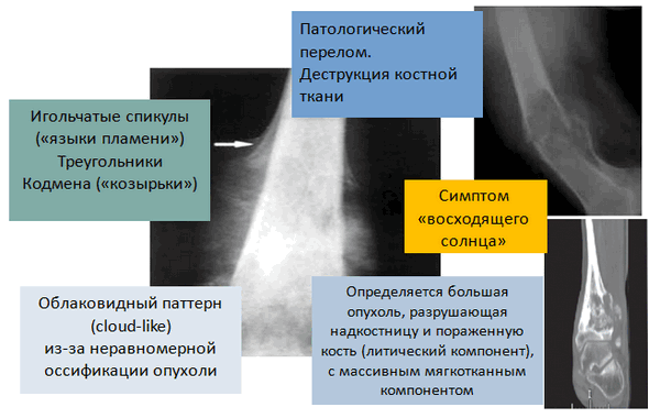 Рис. 2. Рентгенологические признаки остеогенной саркомы